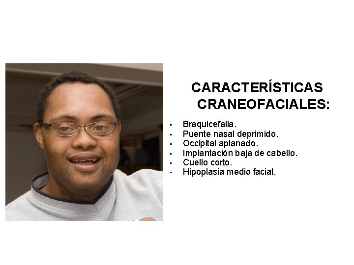 CARACTERÍSTICAS CRANEOFACIALES: • • • Braquicefalia. Puente nasal deprimido. Occipital aplanado. Implantación baja de