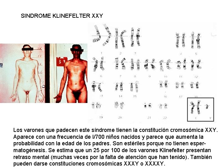 SINDROME KLINEFELTER XXY Los varones que padecen este síndrome tienen la constitución cromosómica XXY.