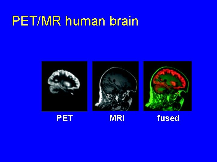 PET/MR human brain PET MRI fused 