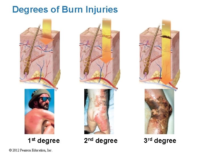 Degrees of Burn Injuries Copyright © The Mc. Graw-Hill Companies, Inc. Permission required for