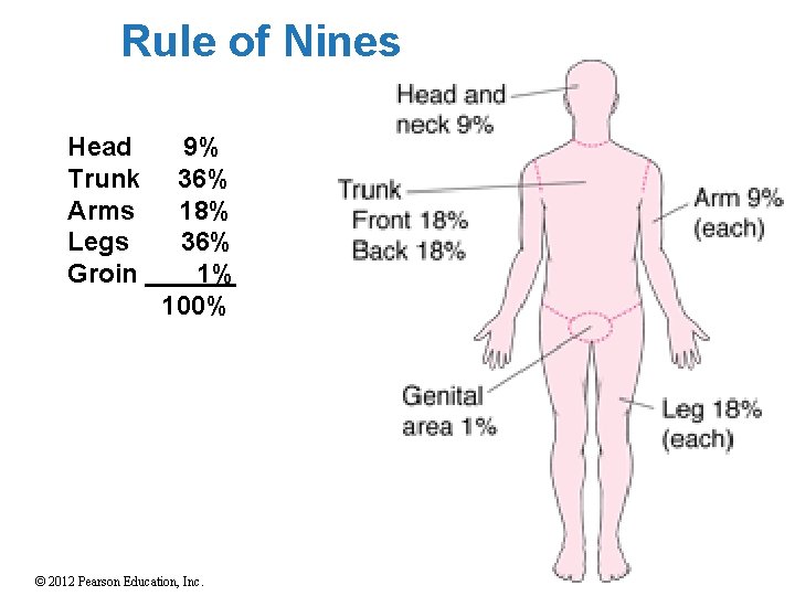 Rule of Nines Head Trunk Arms Legs Groin 9% 36% 18% 36% 1% 100%