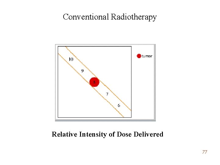 Conventional Radiotherapy Relative Intensity of Dose Delivered 77 