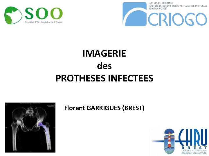 IMAGERIE des PROTHESES INFECTEES Florent GARRIGUES (BREST) 1/XX 