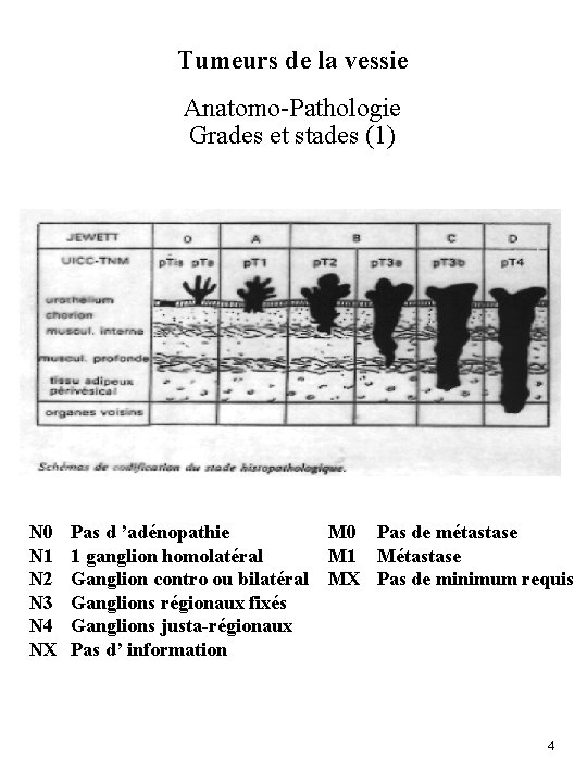 Tumeurs de la vessie Anatomo-Pathologie Grades et stades (1) N 0 N 1 N