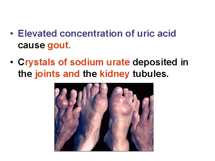  • Elevated concentration of uric acid cause gout. • Crystals of sodium urate