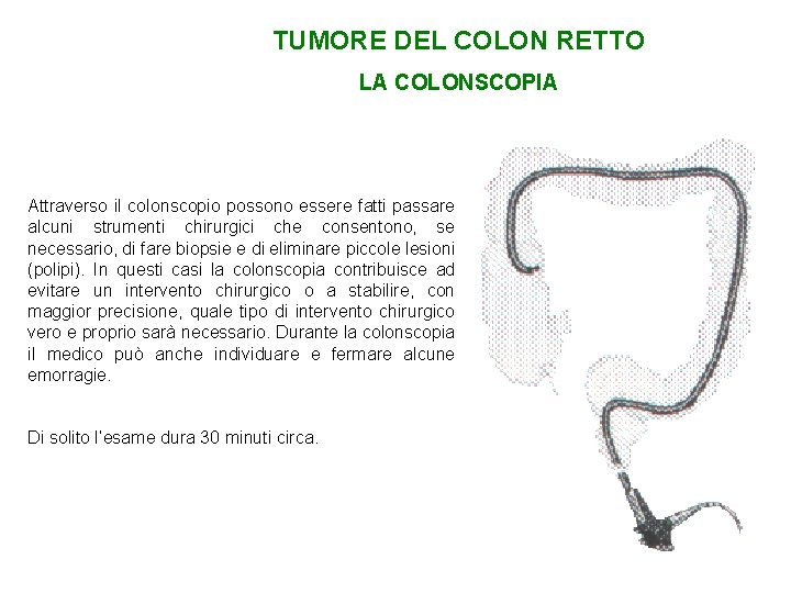 TUMORE DEL COLON RETTO LA COLONSCOPIA Attraverso il colonscopio possono essere fatti passare alcuni