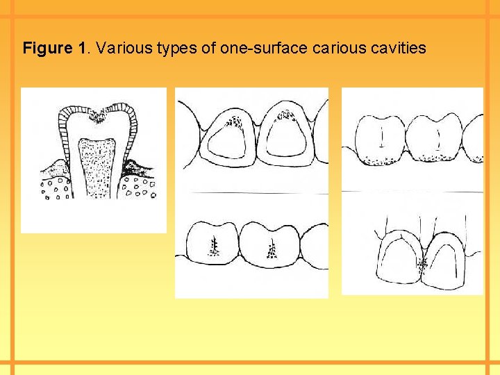 Figure 1. Various types of one-surface carious cavities 