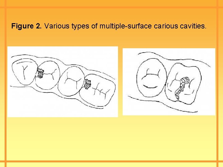 Figure 2. Various types of multiple-surface carious cavities. 
