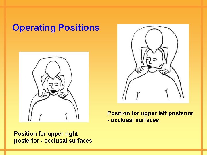 Operating Positions Position for upper left posterior - occlusal surfaces Position for upper right