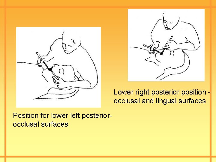 Lower right posterior position occlusal and lingual surfaces Position for lower left posteriorocclusal surfaces