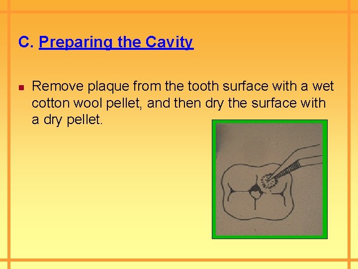 C. Preparing the Cavity n Remove plaque from the tooth surface with a wet