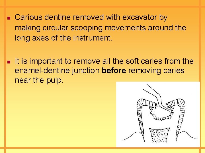 n n Carious dentine removed with excavator by making circular scooping movements around the