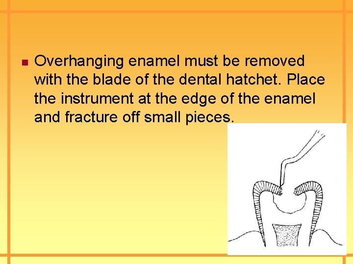 n Overhanging enamel must be removed with the blade of the dental hatchet. Place