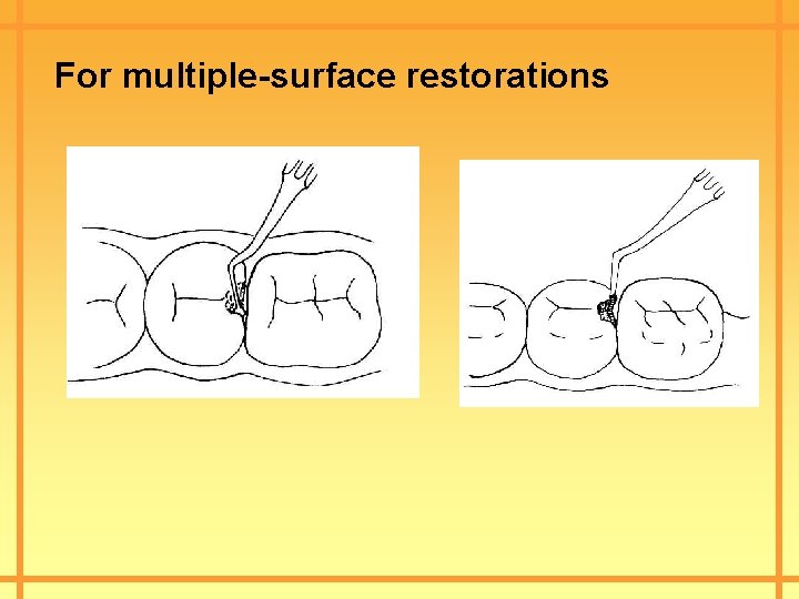 For multiple-surface restorations 