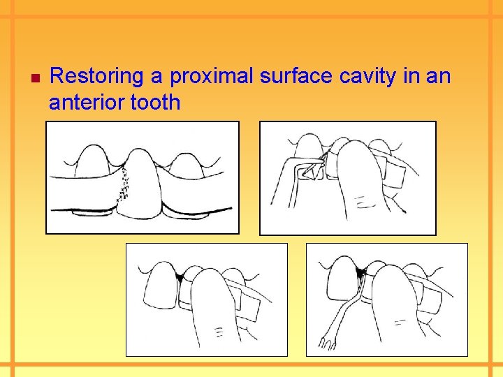 n Restoring a proximal surface cavity in an anterior tooth 
