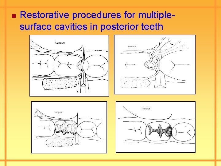 n Restorative procedures for multiplesurface cavities in posterior teeth 