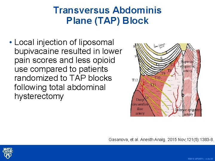 Transversus Abdominis Plane (TAP) Block • Local injection of liposomal bupivacaine resulted in lower