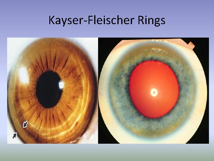 Kayser-Fleischer Rings 