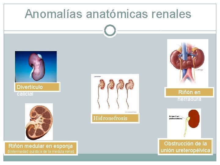 Anomalías anatómicas renales Divertículo calicial Riñón en herradura Hidronefrosis Riñón medular en esponja (Enfermedad