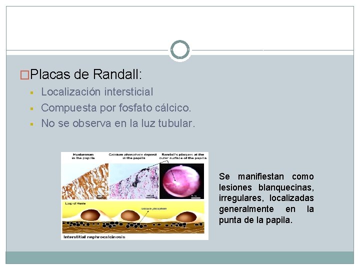 �Placas de Randall: § § § Localización intersticial Compuesta por fosfato cálcico. No se