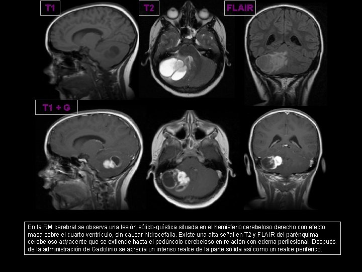 T 1 T 2 FLAIR T 1 + G En la RM cerebral se