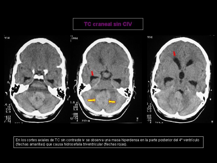 TC craneal sin CIV En los cortes axiales de TC sin contraste iv se
