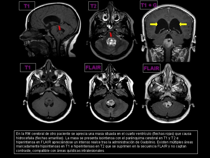 T 1 T 2 T 1 FLAIR T 1 + G FLAIR En la