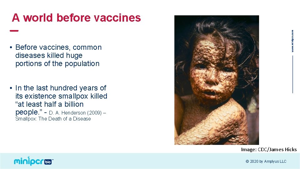A world before vaccines • Before vaccines, common diseases killed huge portions of the
