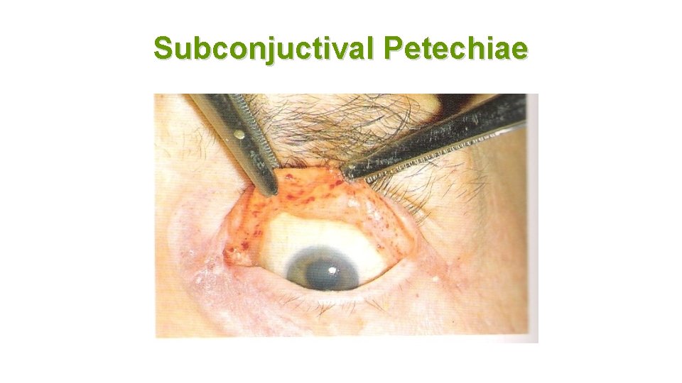Subconjuctival Petechiae 