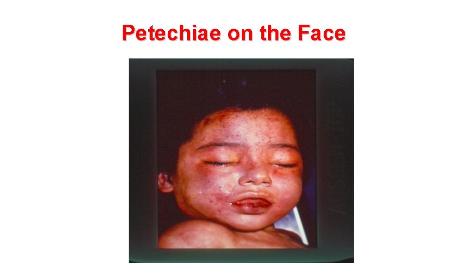 Petechiae on the Face 