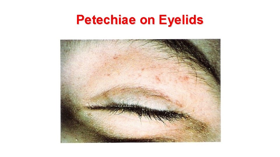 Petechiae on Eyelids 