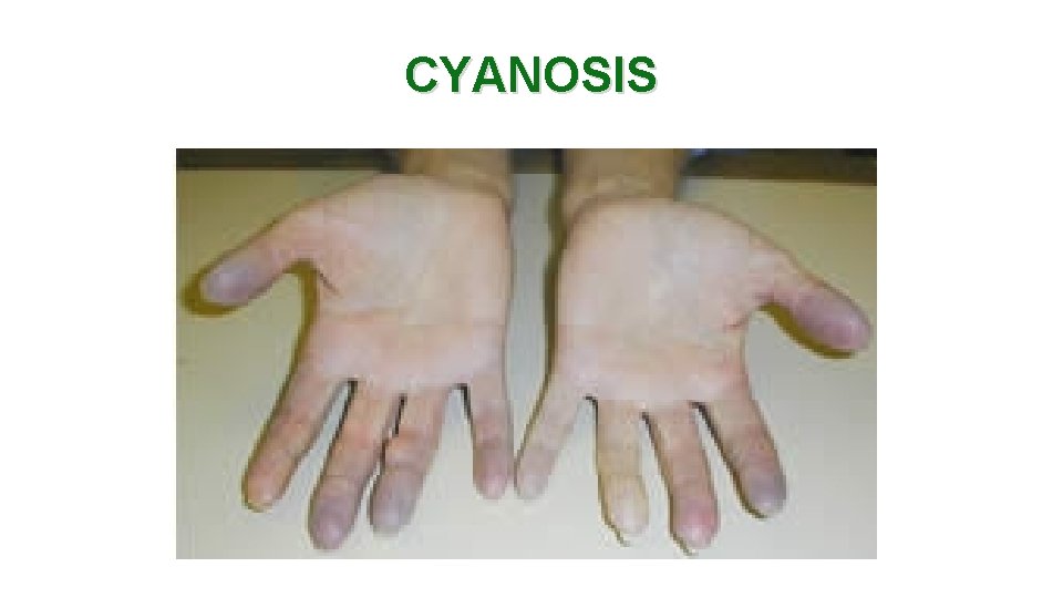 CYANOSIS 