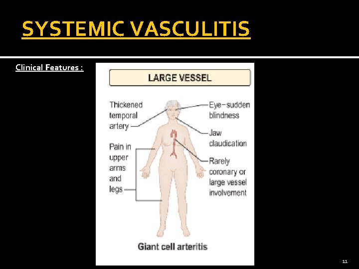 SYSTEMIC VASCULITIS Clinical Features : 11 