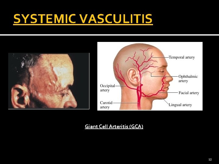 SYSTEMIC VASCULITIS Giant Cell Arteritis (GCA) 12 