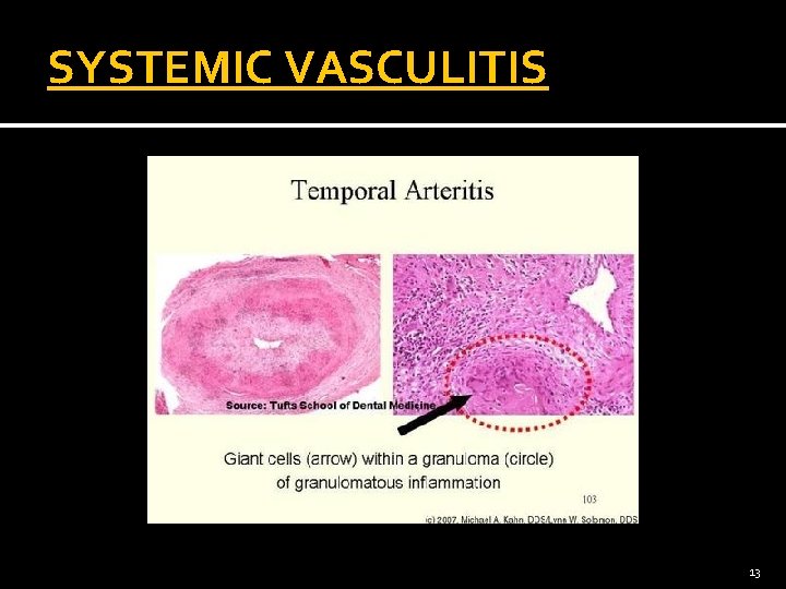 SYSTEMIC VASCULITIS 13 