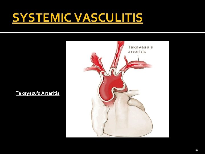 SYSTEMIC VASCULITIS Takayasu’s Arteritis 17 