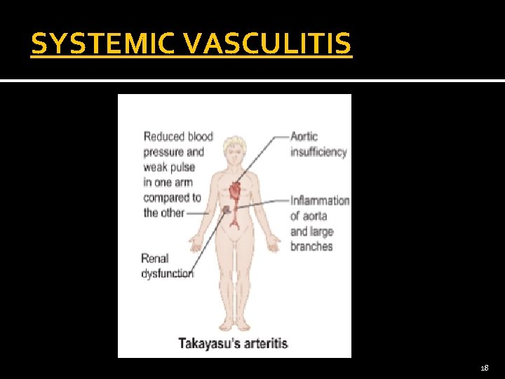 SYSTEMIC VASCULITIS 18 