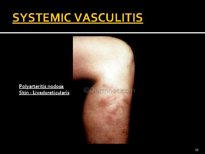 SYSTEMIC VASCULITIS Polyarteritis nodosa Skin - Livedoreticularis 25 