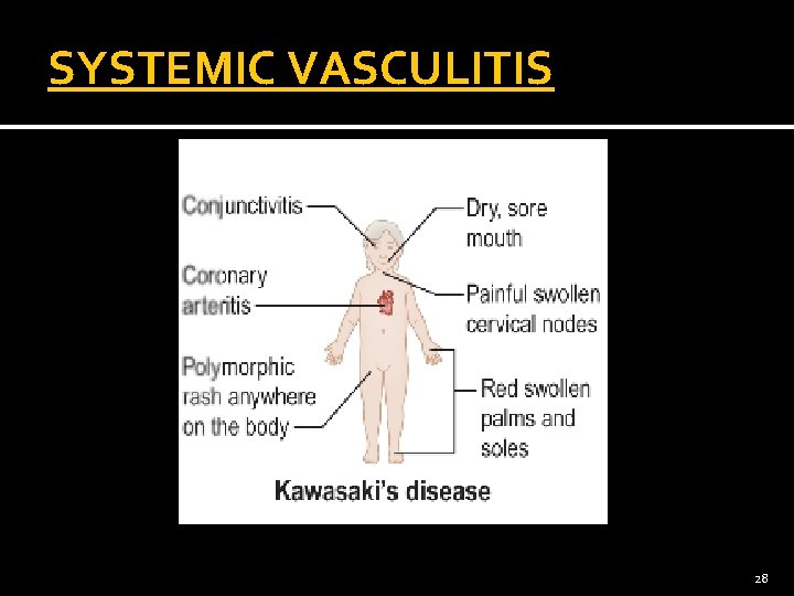 SYSTEMIC VASCULITIS 28 
