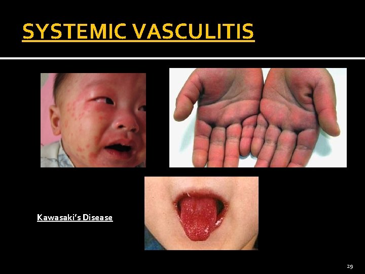 SYSTEMIC VASCULITIS Kawasaki’s Disease 29 