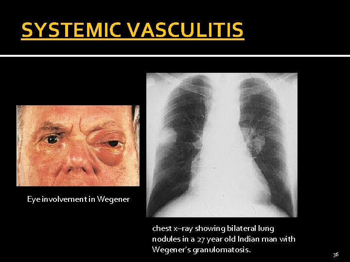 SYSTEMIC VASCULITIS Eye involvement in Wegener chest x–ray showing bilateral lung nodules in a