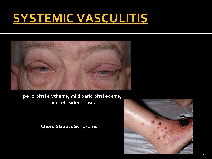 SYSTEMIC VASCULITIS periorbital erythema, mild periorbital edema, and left-sided ptosis Churg Strauss Syndrome 40