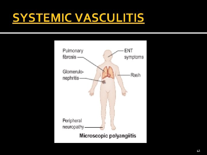 SYSTEMIC VASCULITIS 42 
