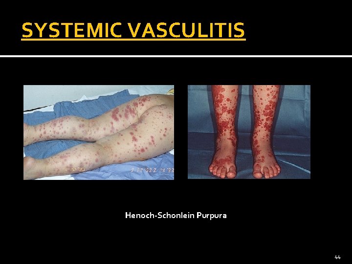 SYSTEMIC VASCULITIS Henoch-Schonlein Purpura 44 