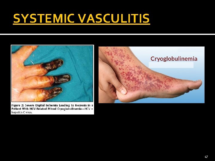 SYSTEMIC VASCULITIS 47 