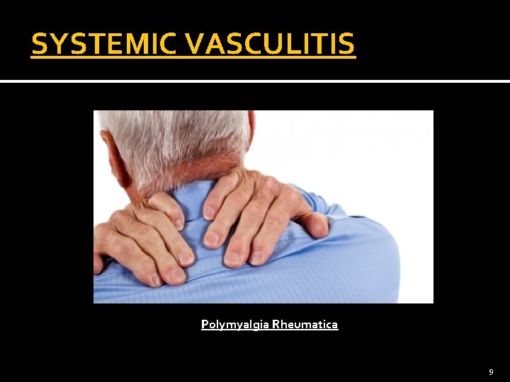 SYSTEMIC VASCULITIS Polymyalgia Rheumatica 9 