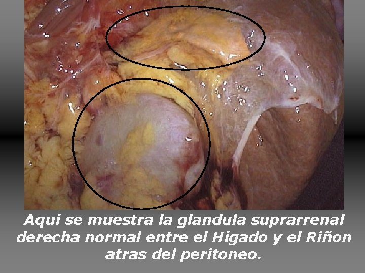 Aqui se muestra la glandula suprarrenal derecha normal entre el Higado y el Riñon Aqui se muestra la glandula suprarrenal derecha normal entre el Higado y el Riñon
