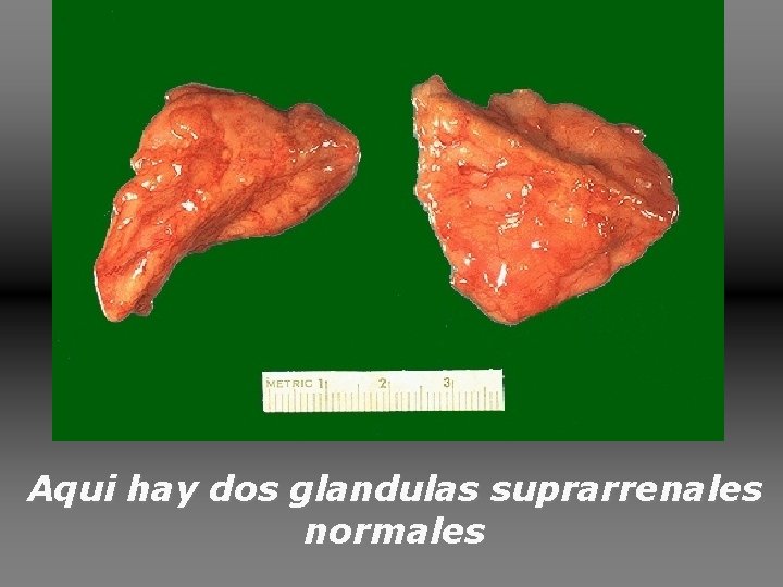 Aqui hay dos glandulas suprarrenales normales Aqui hay dos glandulas suprarrenales normales