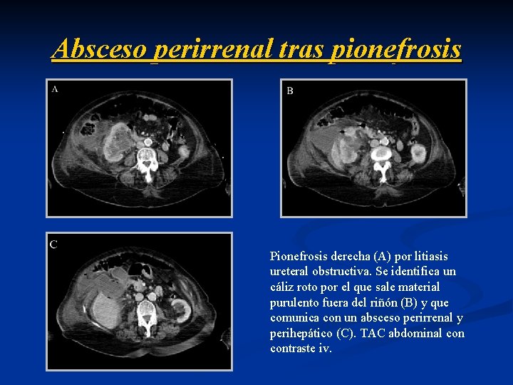 Absceso perirrenal tras pionefrosis Pionefrosis derecha (A) por litiasis ureteral obstructiva. Se identifica un