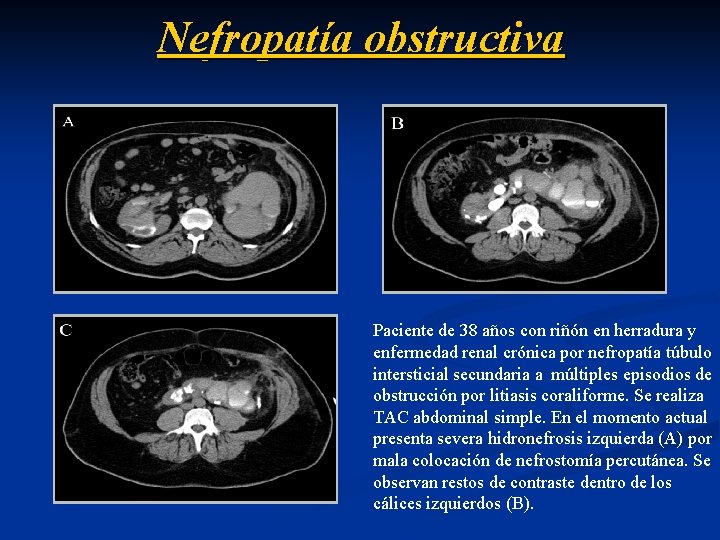 Nefropatía obstructiva Paciente de 38 años con riñón en herradura y enfermedad renal crónica